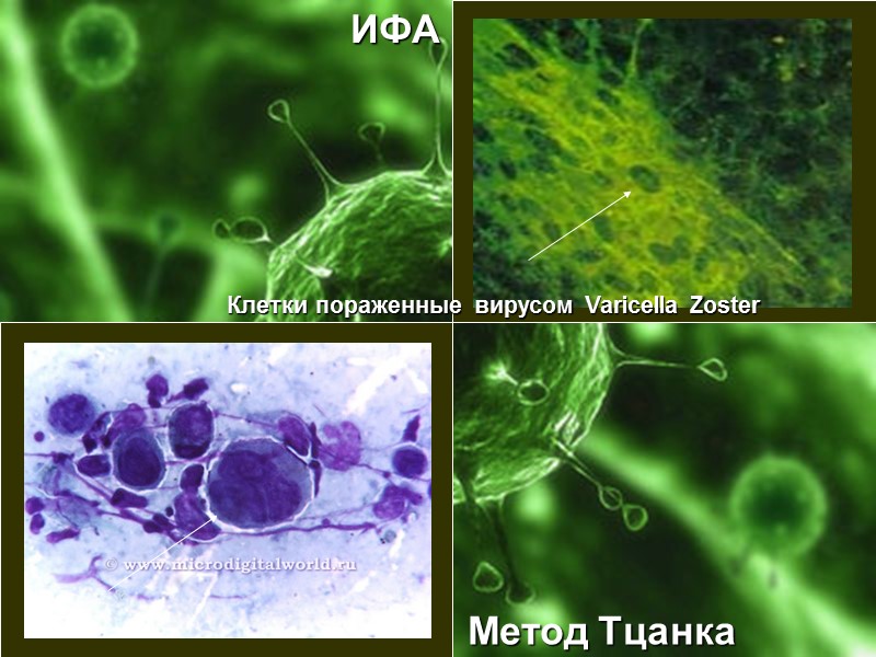 ИФА Метод Тцанка Клетки пораженные вирусом Varicella Zoster